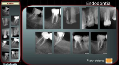 Endodontia Casos