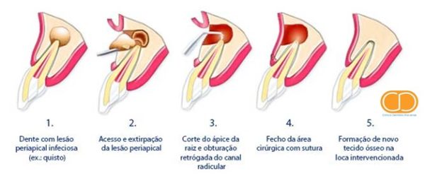 Procedimento de Apicectomia usado
