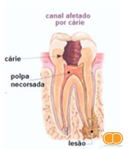 Desvitalização Dentária1