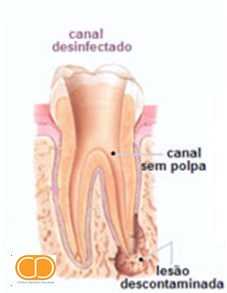Desvitalizazção Dentaria2