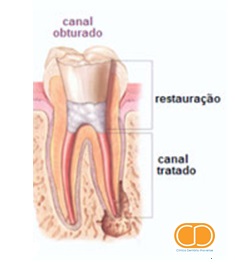 Desvitalização Dentária3
