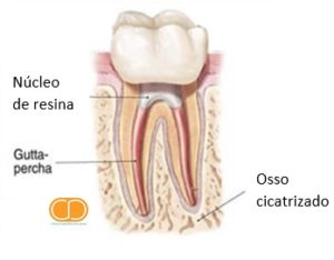 Desvitalização Dentaria4