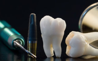 Implantes Dentários Múltiplos