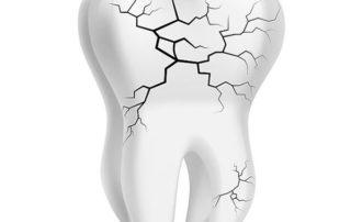 Síndrome de dente Fissurado e Fratura Vertical da Raiz